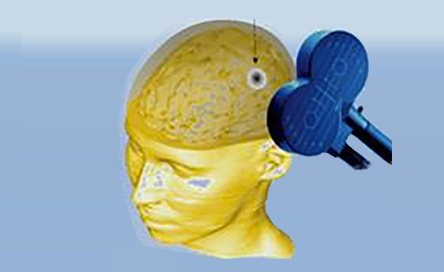 JAD 85:4_PR1 visual (brain stimulation illustration)